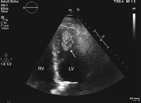 lv thrombus treatment|lv mural thrombus treatment guidelines.